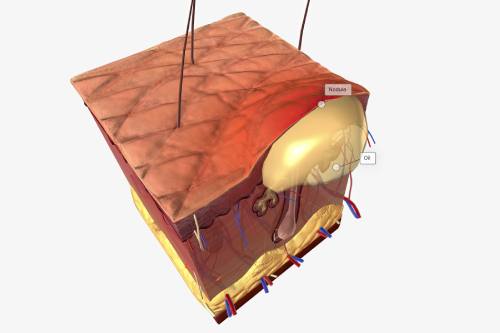 Exéresis de Lipomas