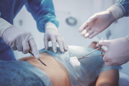 Tratamiento Quirúrgico Apendicitis